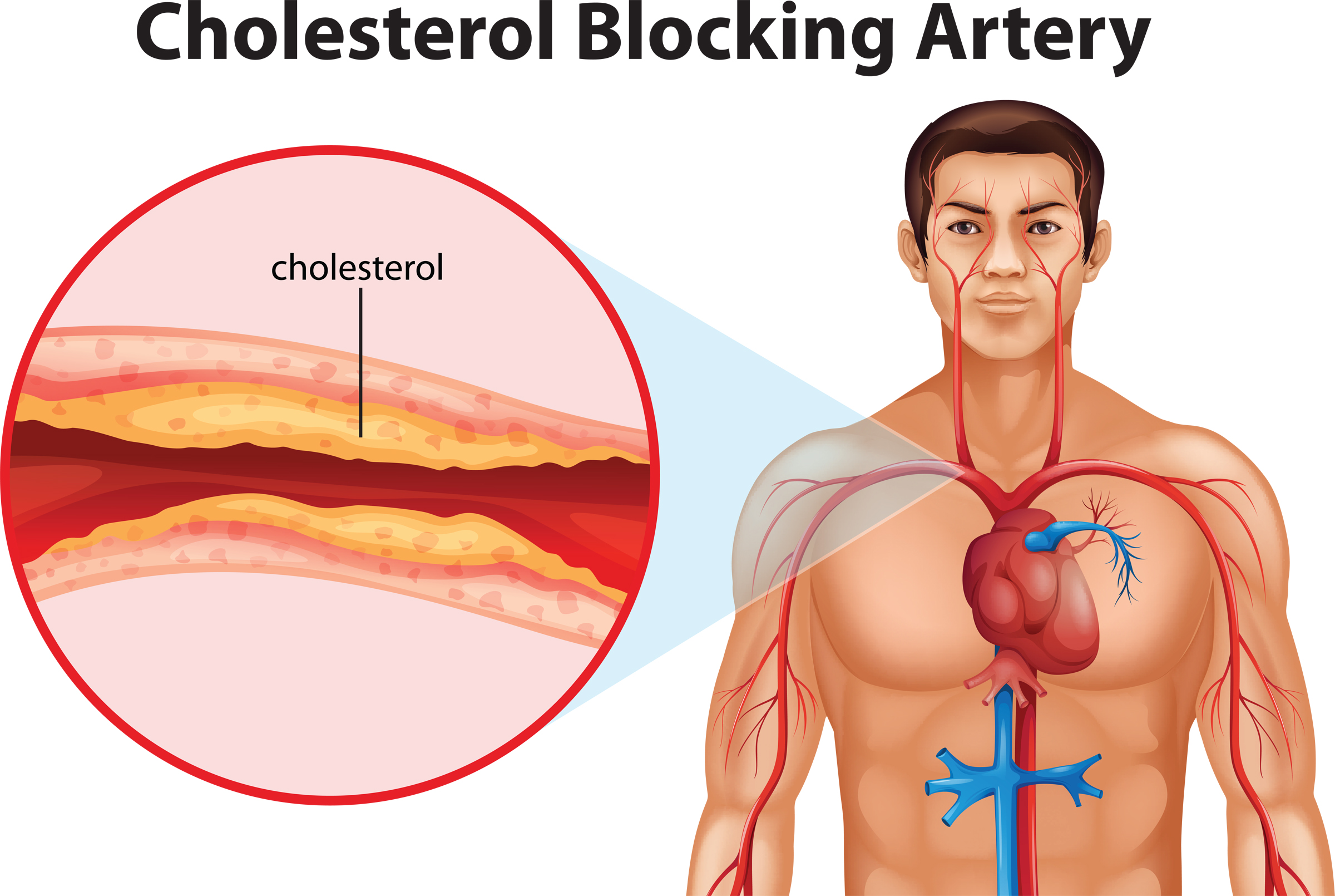 CholesterolThe Good, the bad and . . . - BEAR LAKE MEMORIAL